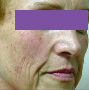 Laser Skin Resurfacing, Pixel Laser, London - Dermacure