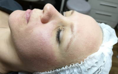 Why you should consider getting i-Pixel laser skin resurfacing treatment