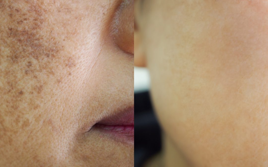 What is Skin Pigmentation and what causes it?