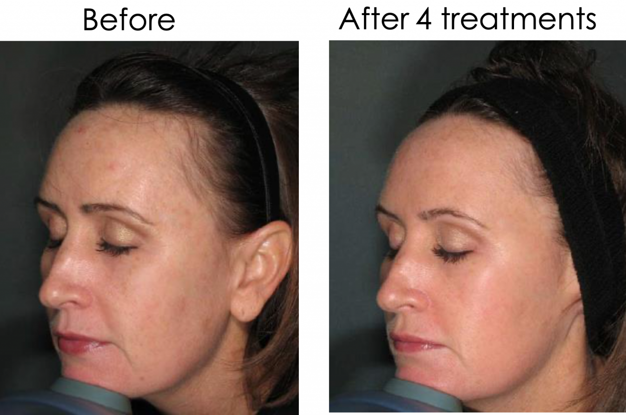 CleaLift, Laser Lift Treatment For Face, London Dermacure