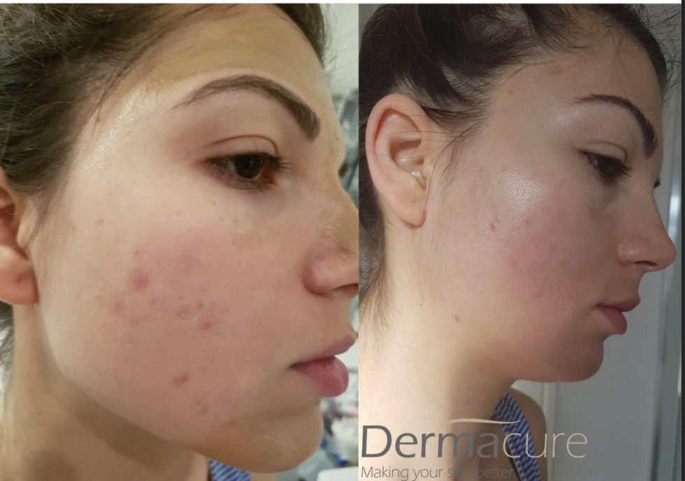 Cosmelan Peel London Number 1 Depigmentation