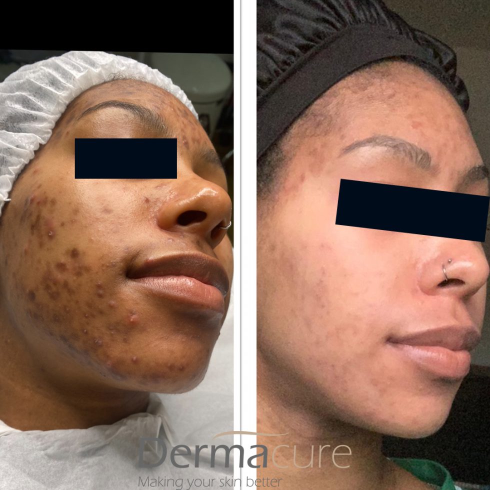 Cosmelan Peel London | Number 1 Depigmentation Treatment | Dermacure Clinic