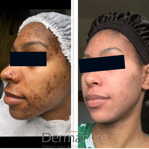 Cosmelan Peel London | Number 1 Depigmentation Treatment | Dermacure Clinic