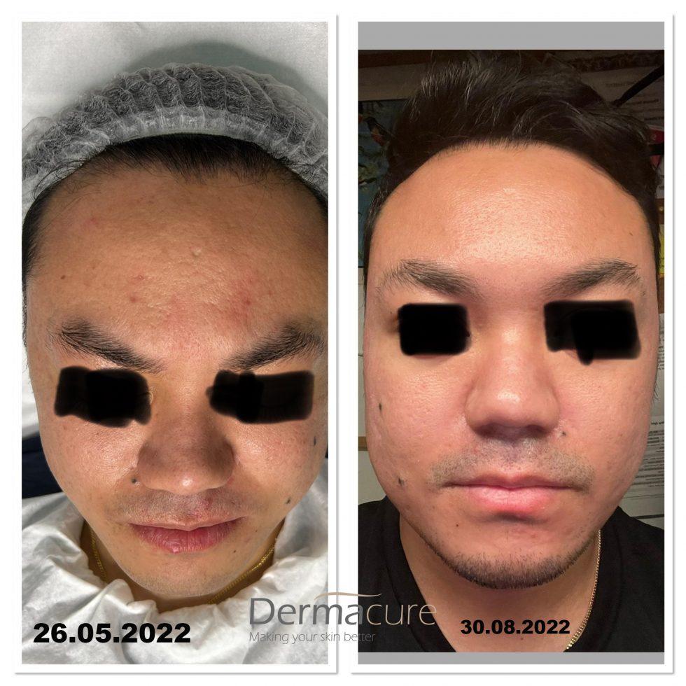 Laser Skin Resurfacing, Pixel Laser, London Dermacure