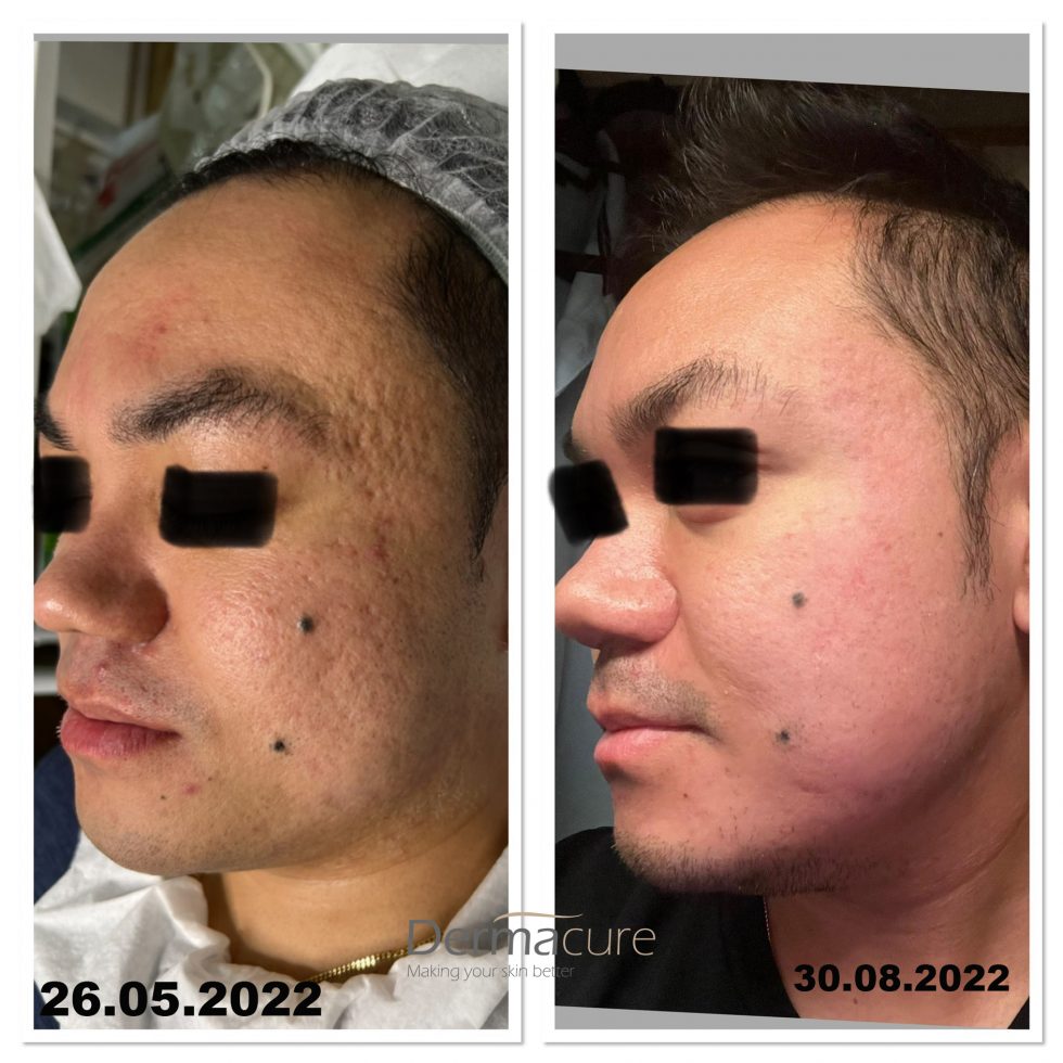 Laser Skin Resurfacing, Pixel Laser, London Dermacure
