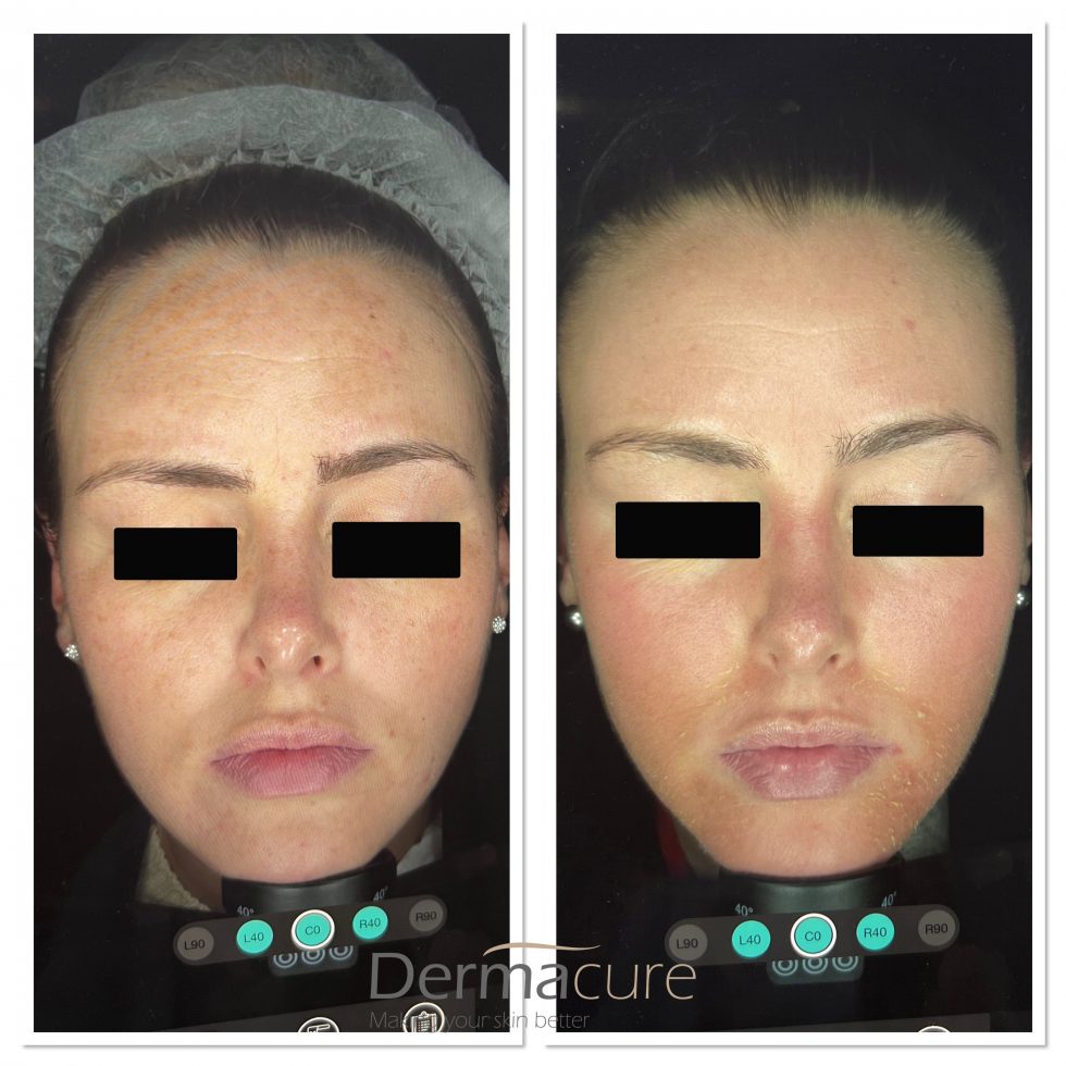 Cosmelan Peel London | Number 1 Depigmentation Treatment | Dermacure Clinic