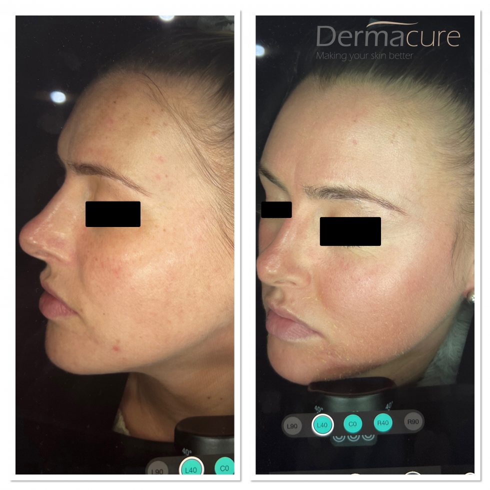 Cosmelan Peel London Number 1 Depigmentation Treatment Dermacure Clinic