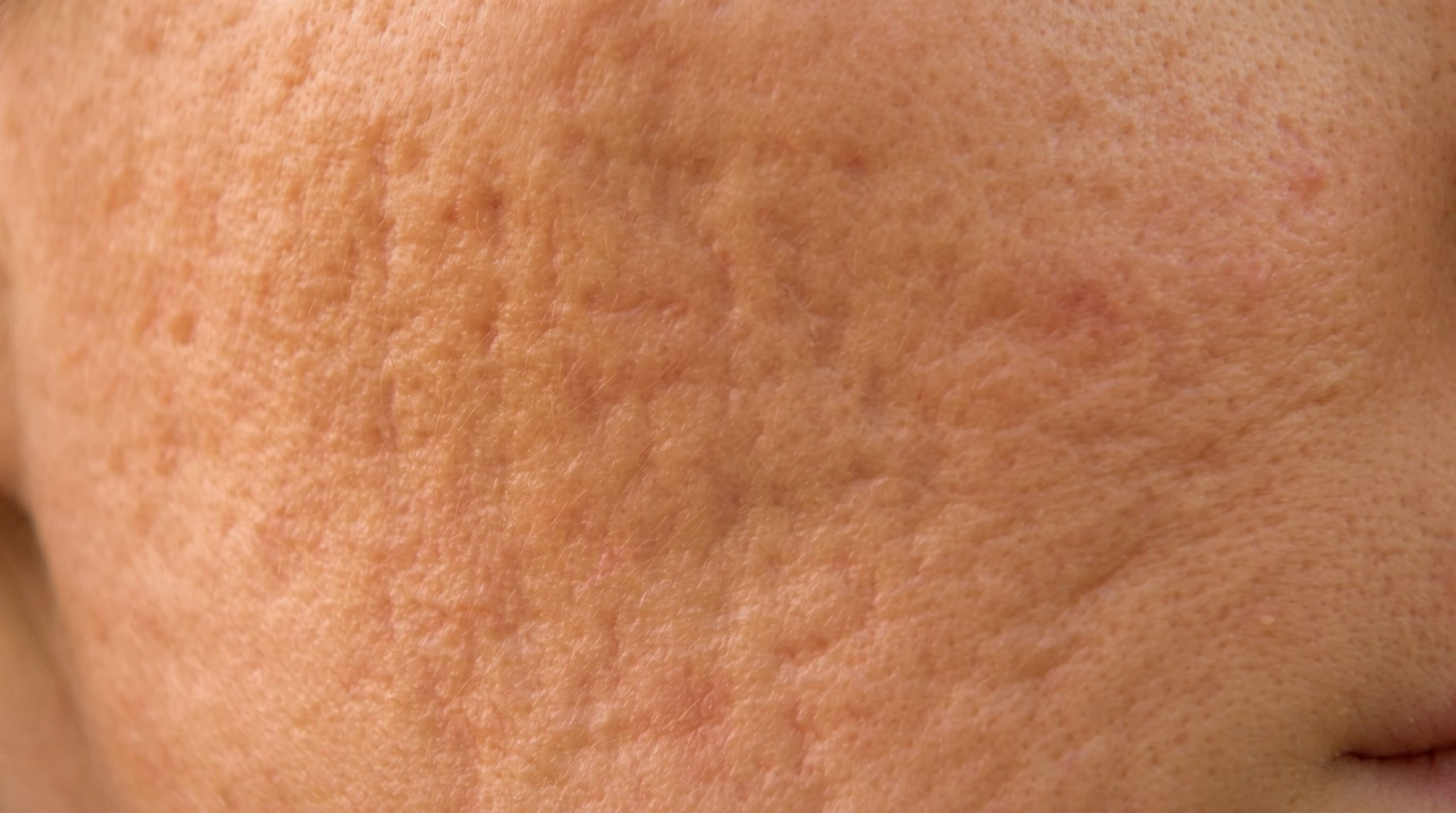 Rolling acne scars