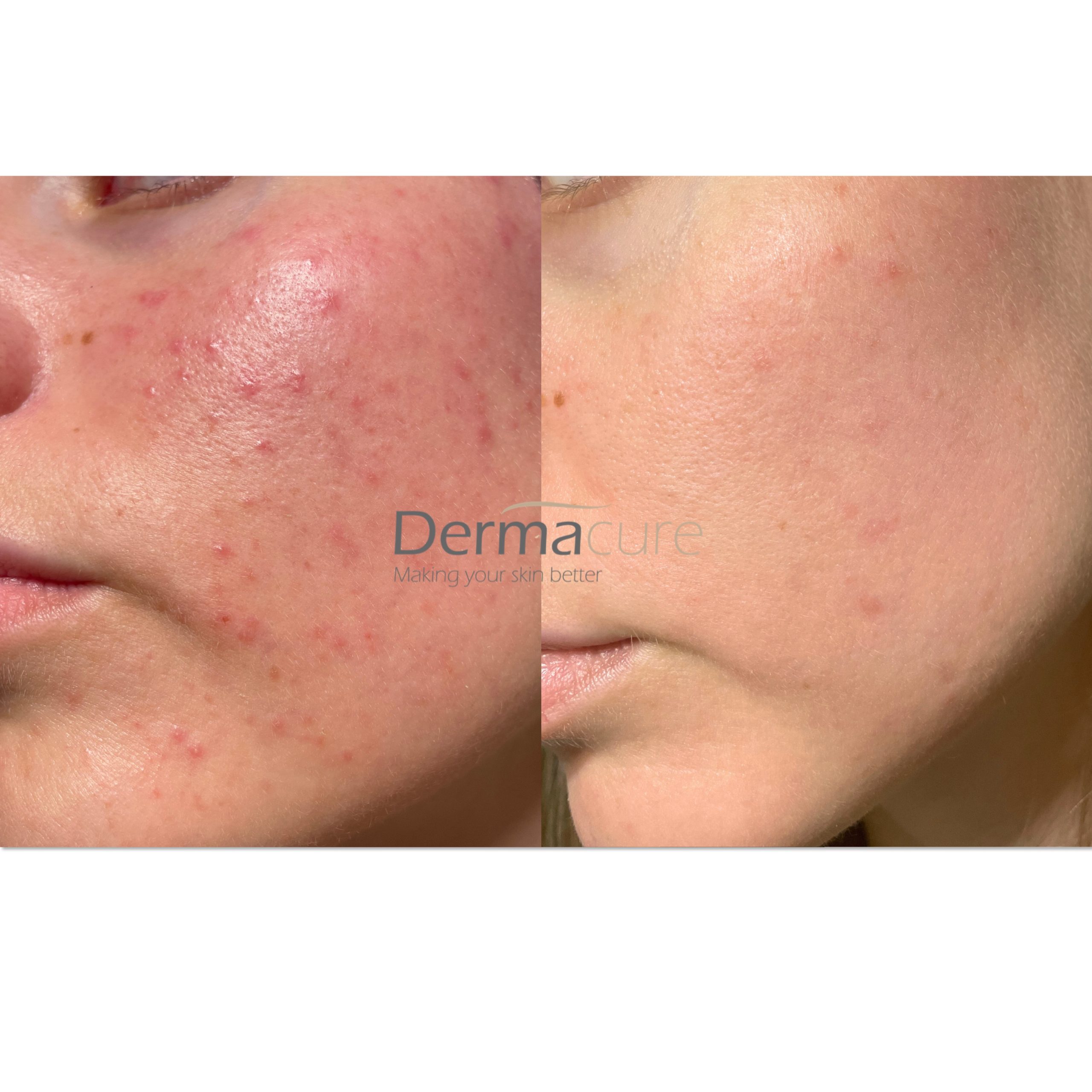 Acne Scars treatment London