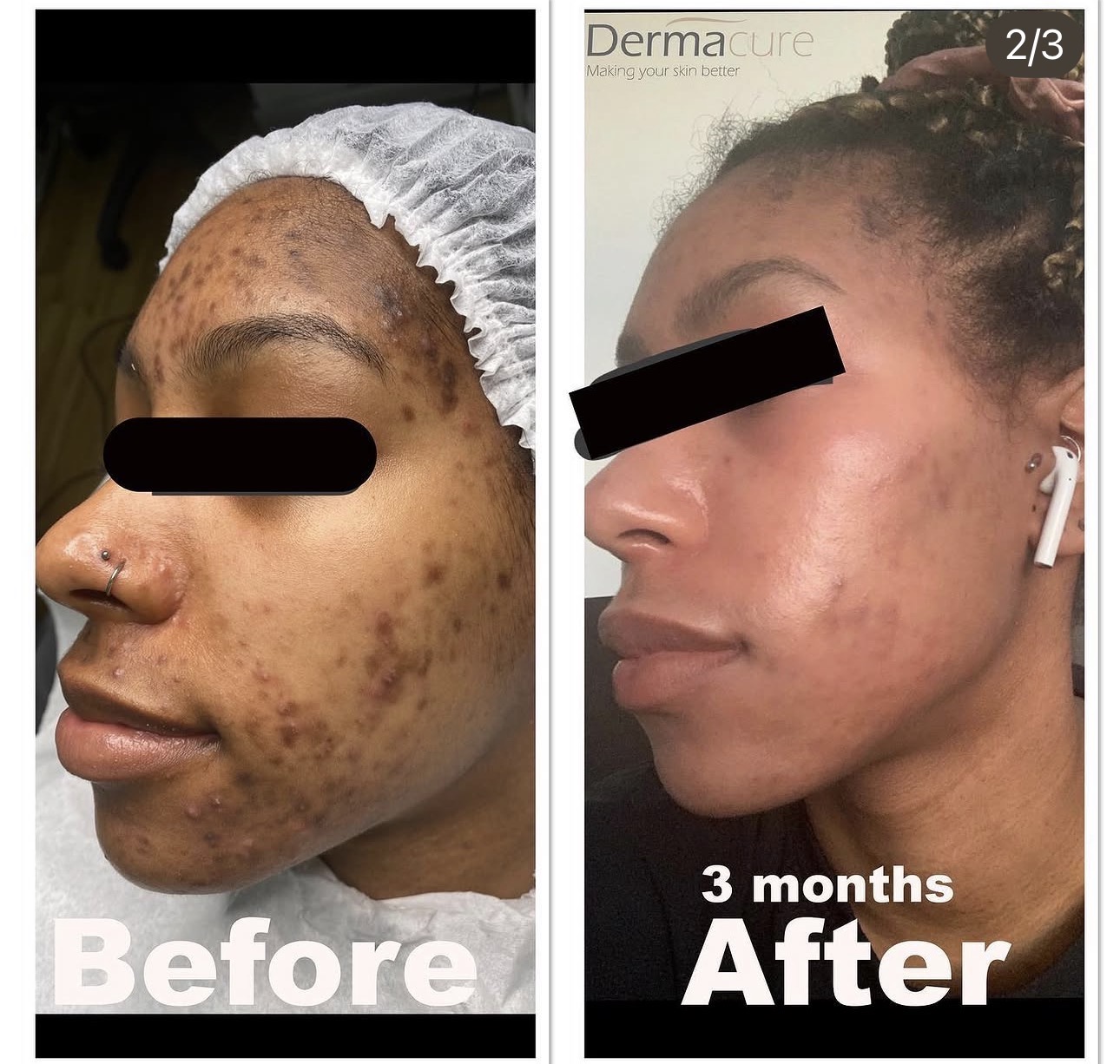 Acne Scars treatment London