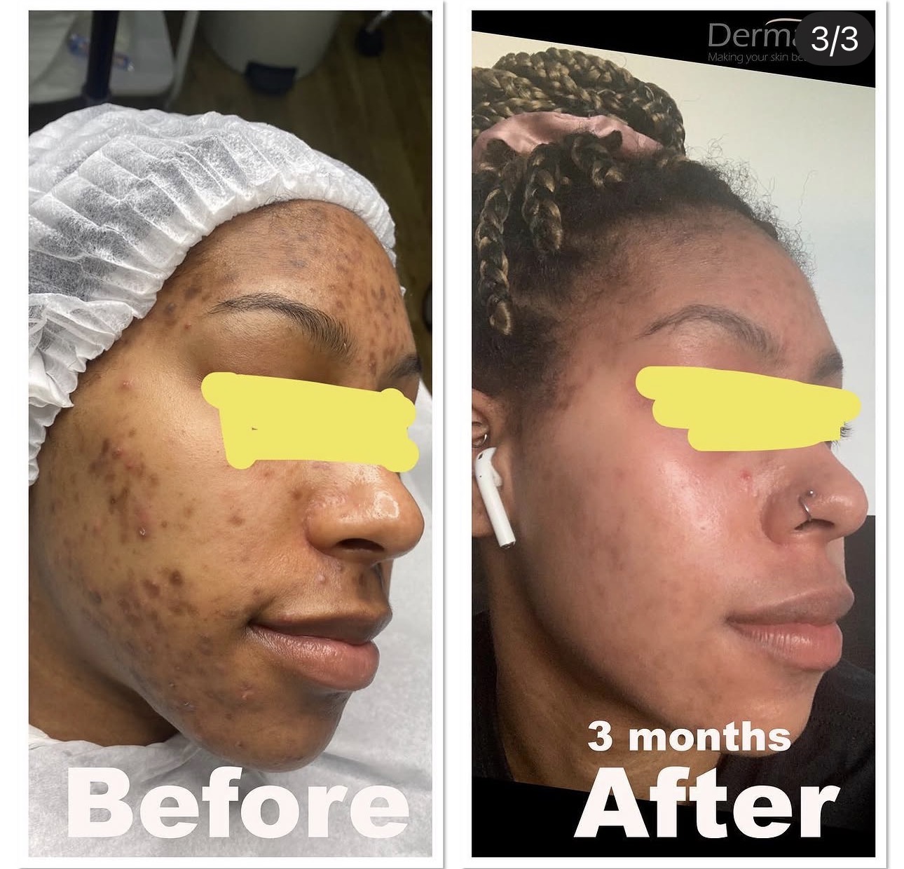 Acne Scars treatment London
