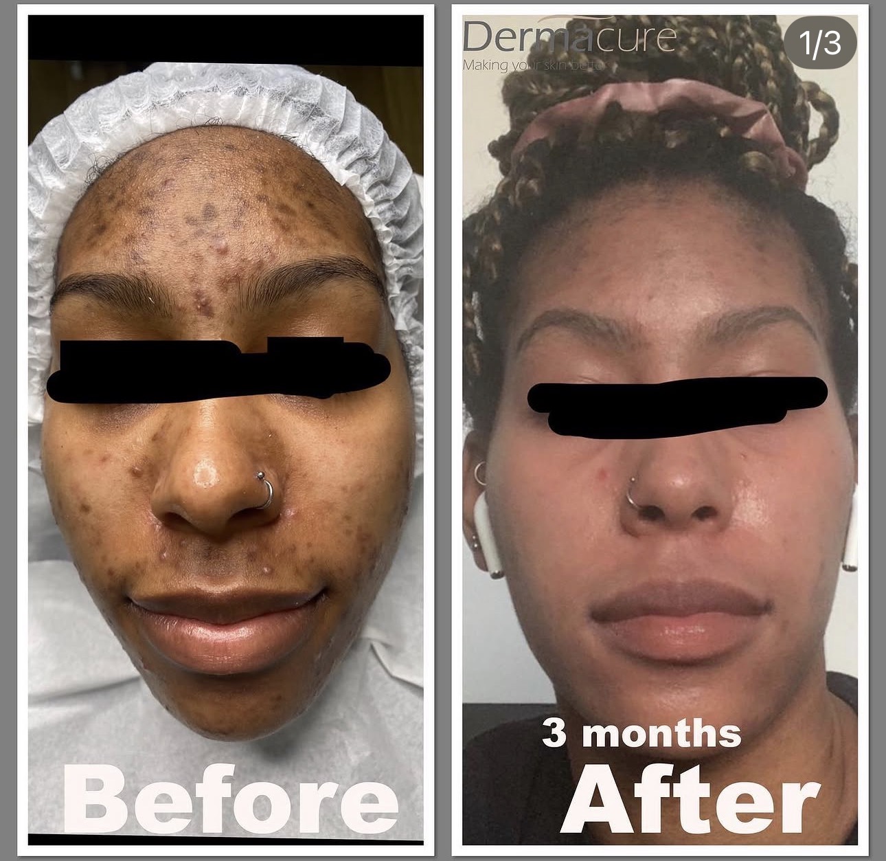 Acne Scars treatment London