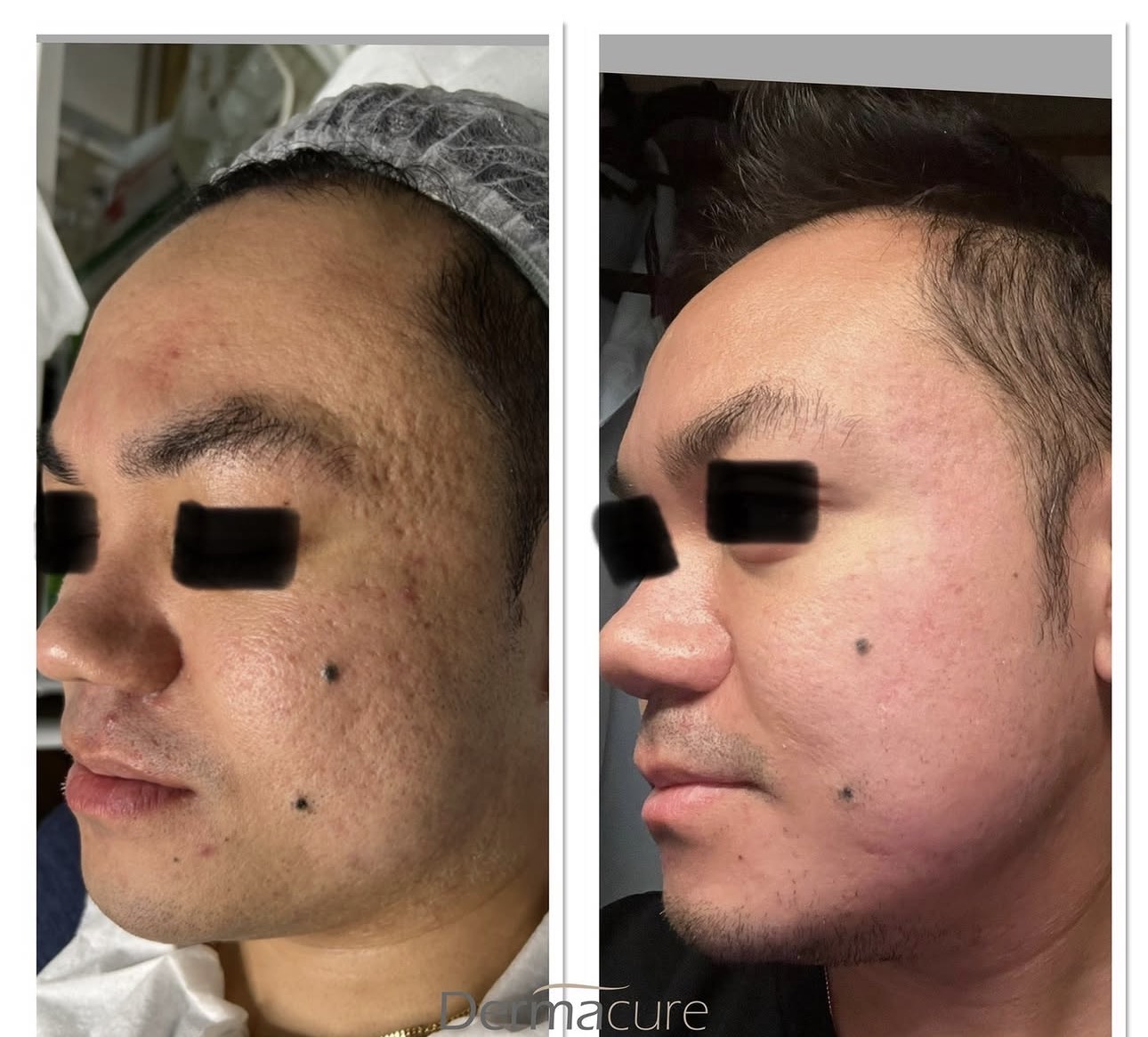 Acne Scars treatment London