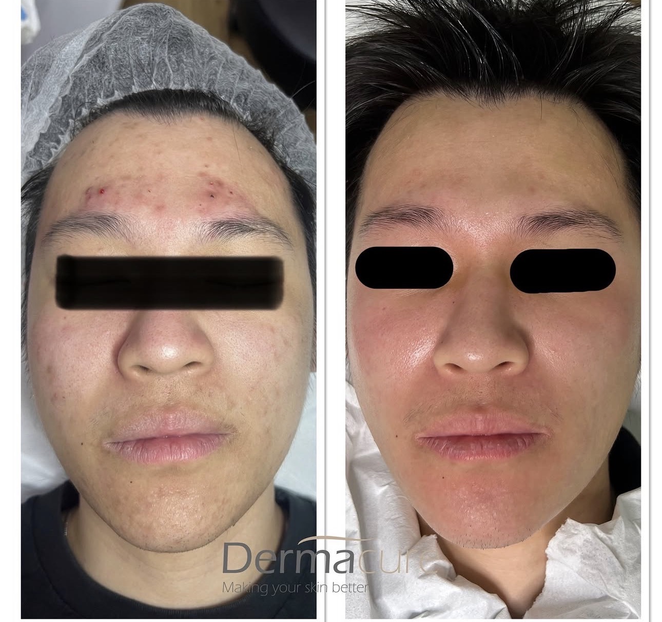 Acne Scars treatment London